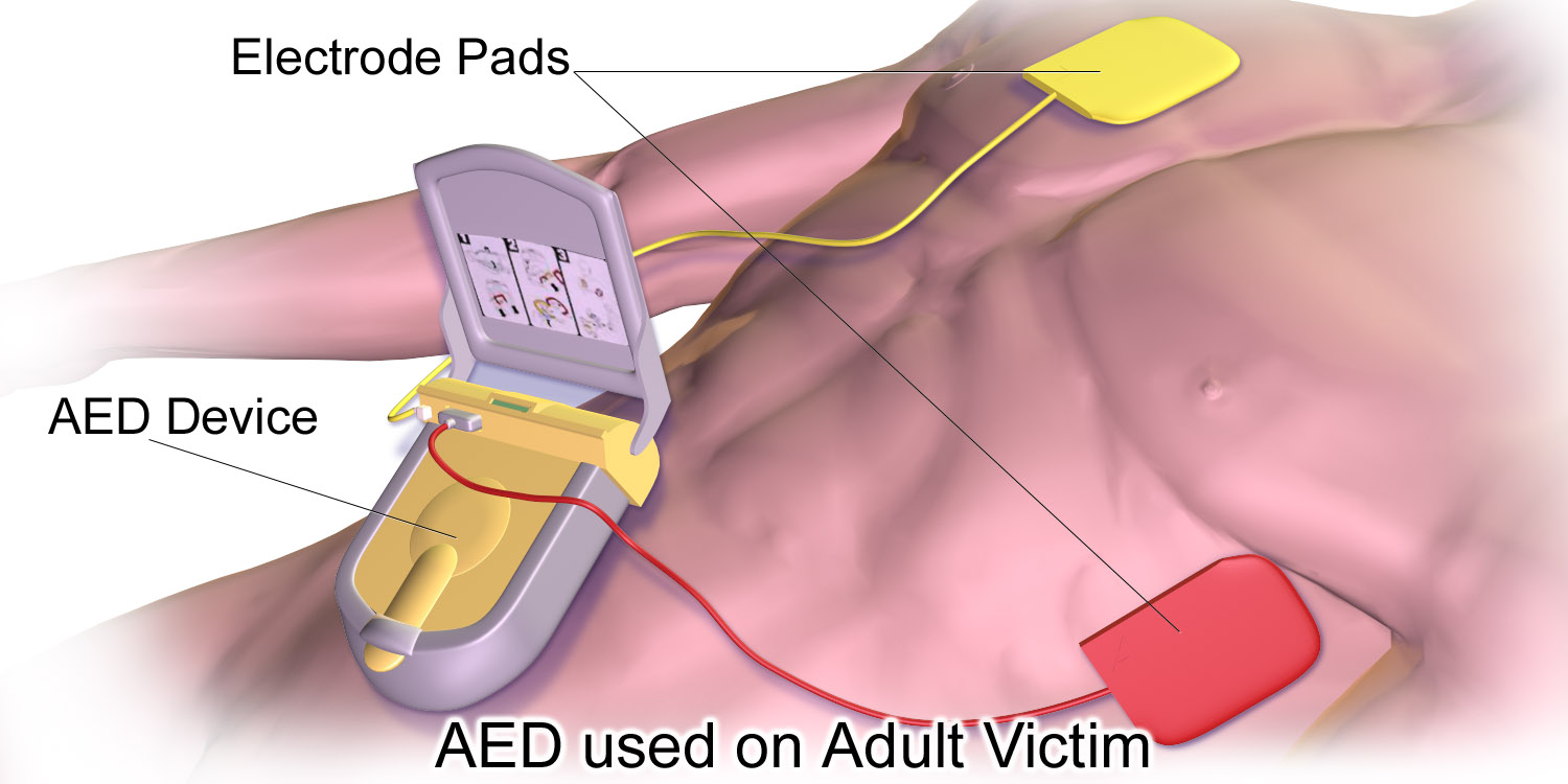 성인에게 자동심장충격기 AED 패드를 부착하는 위치와 기기를 보여주는 의료 일러스트
